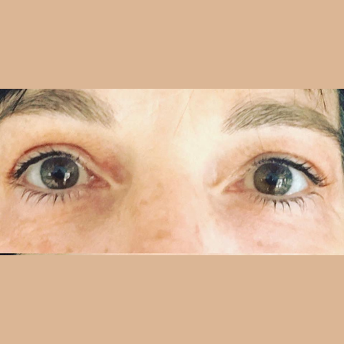 avant apres correction d'un oeil creux