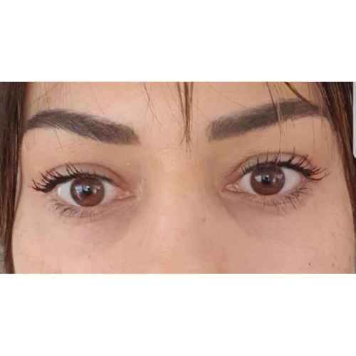 correction de poches palpebraless