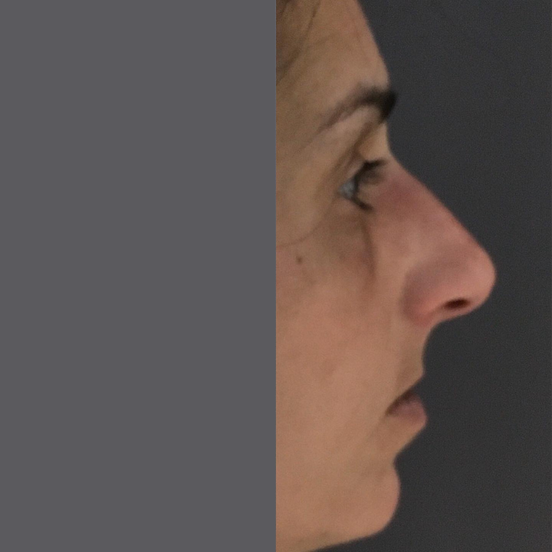 avant apres avant apres rhinoplastie medicale sans chirurgie