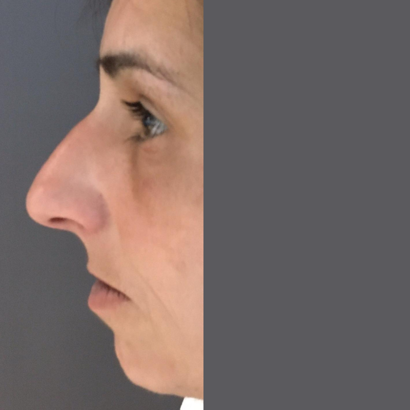 avant apres rhinoplastie medicale sans chirurgie