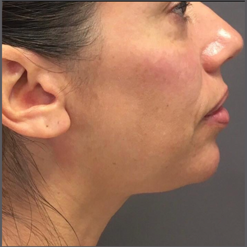 correction de poches palpebraless