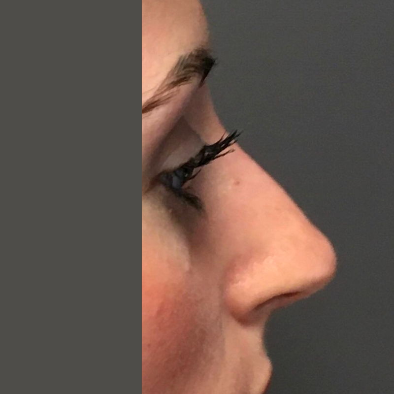 avant apres rhinoplastie