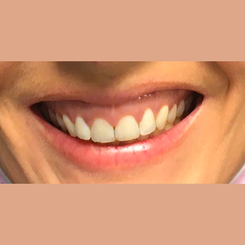 avant apres correction sourire gingival