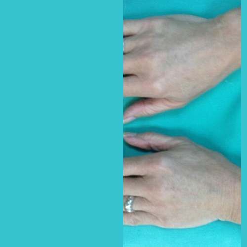 avant apres lissage des rides au laser