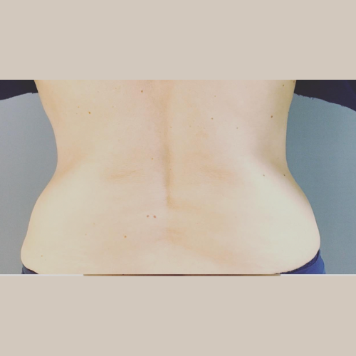 avant apres bourrelet