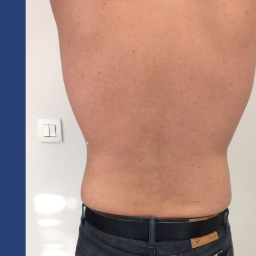 avant apres bourrelet