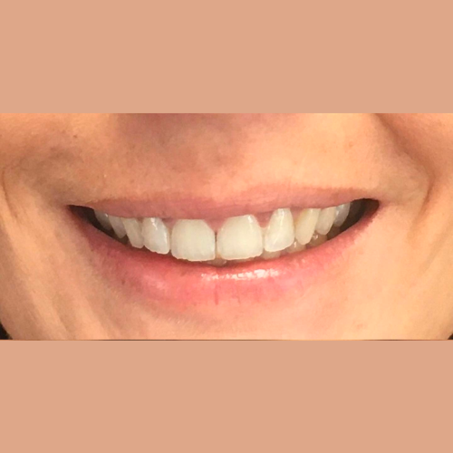 avant apres correction sourire gingival