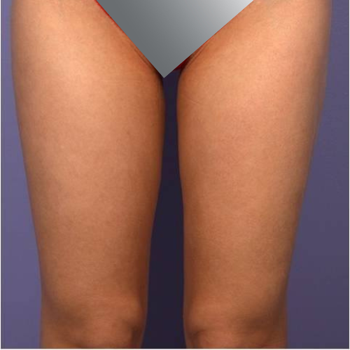 avant apres cellulite cuisses