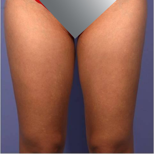 avant apres cellulite cuisses