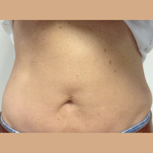 avant / apres coolsculpting