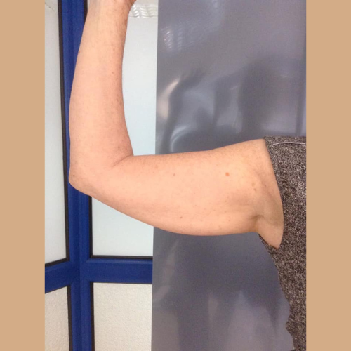 avant apres coolsculpting
