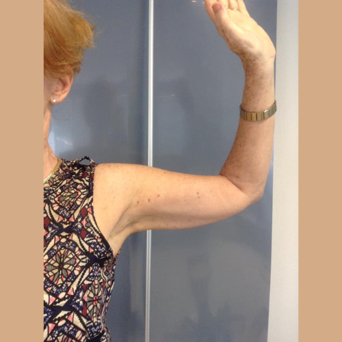 avant apres coolsculpting