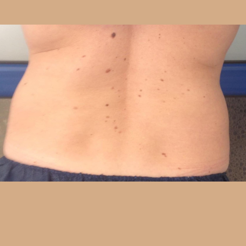 avant / apres coolsculpting