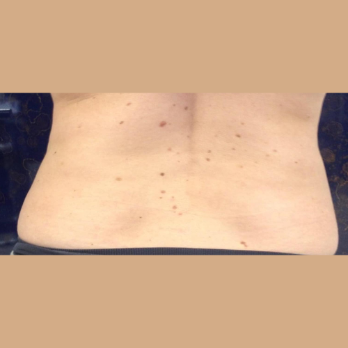 avant / apres coolsculpting