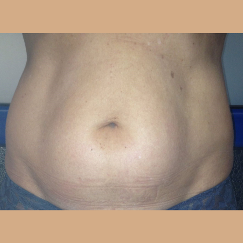 avant / apres coolsculpting