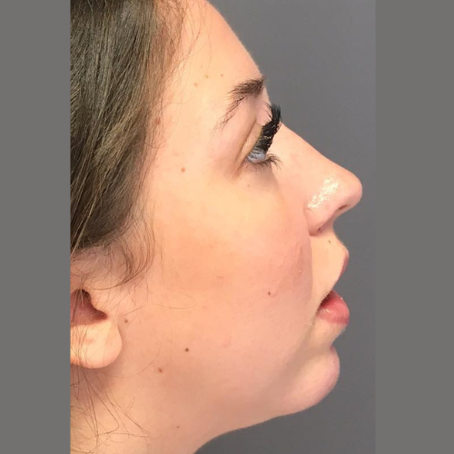 avant apres genioplastie