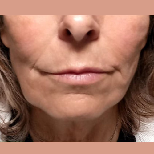 avant apres la rhinoplastie medicale
