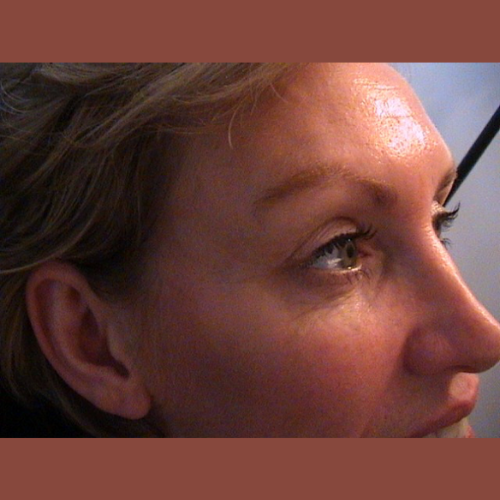 apres botox