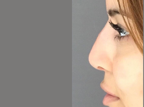 avant / apres rhinoplastie Quezel guerraz