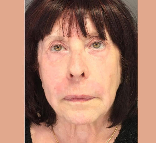 avant / apres rhinoplastie Quezel guerraz