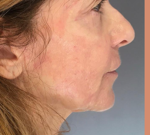 avant / apres rhinoplastie Quezel guerraz