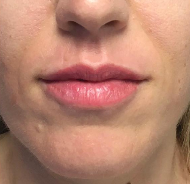 avant apres correction d'un oeil creux