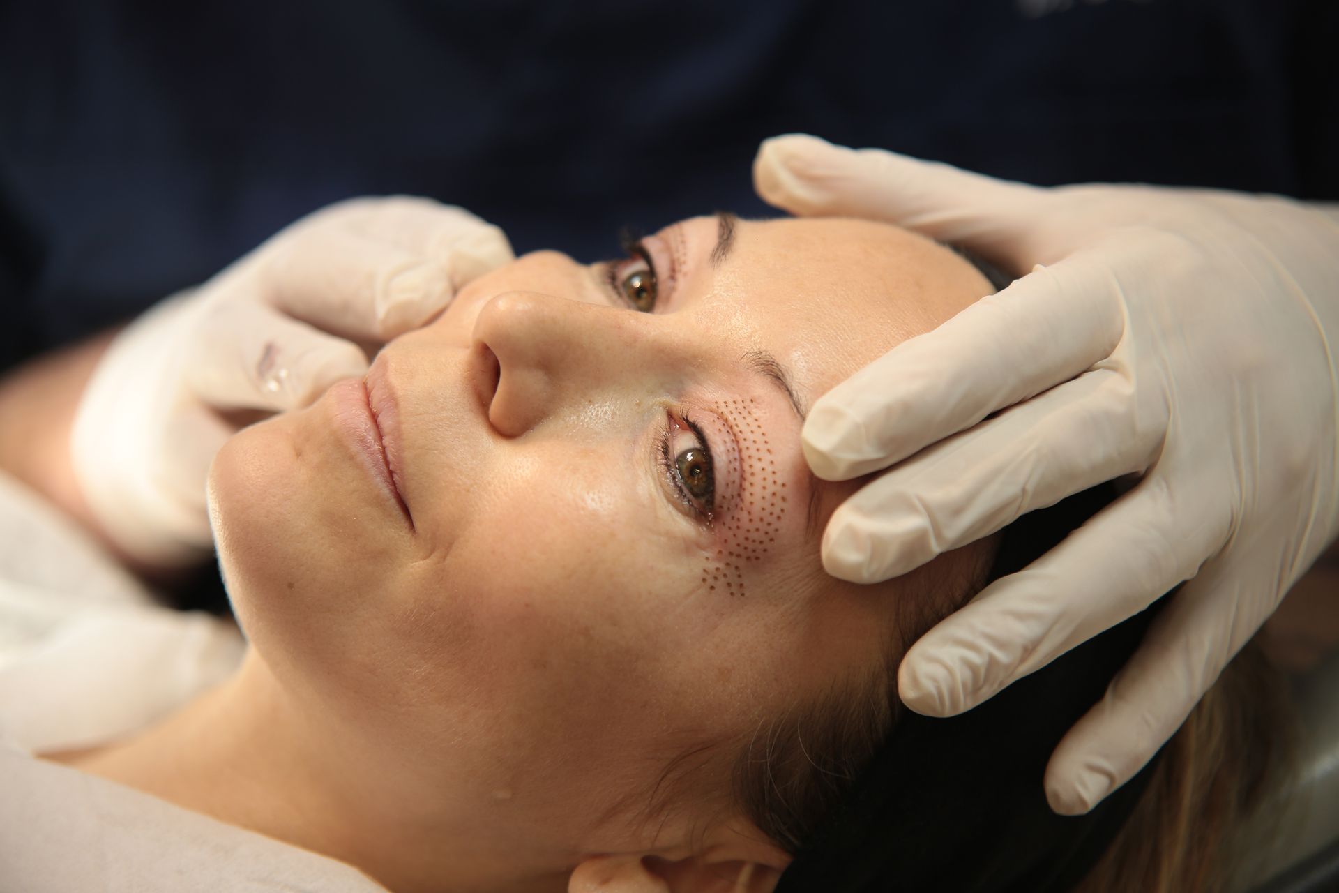 blepharoplastie medicale realisé par le docteur quezel guerraz a perpignan