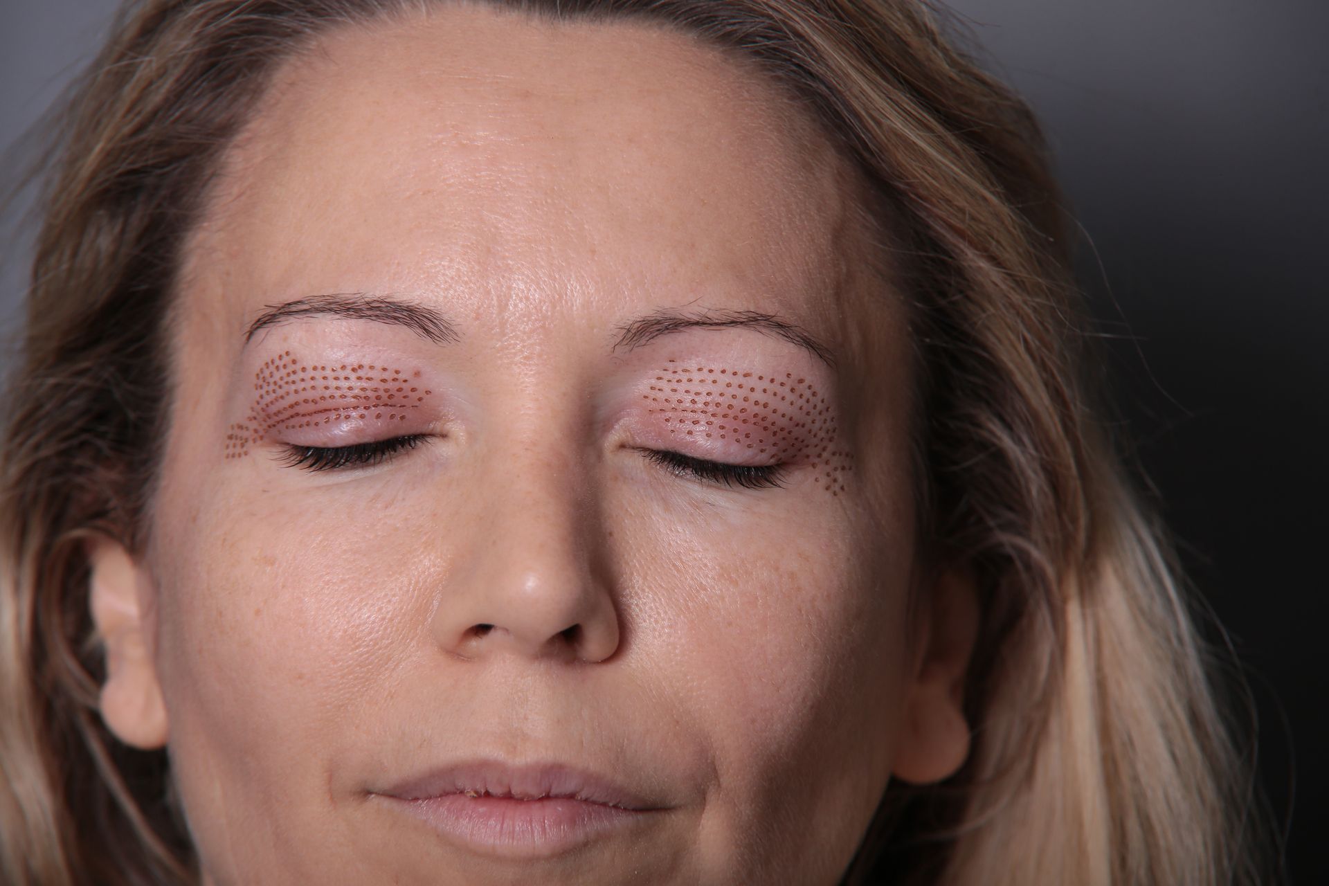 blepharoplastie medicale realisé par le docteur quezel guerraz a perpignan