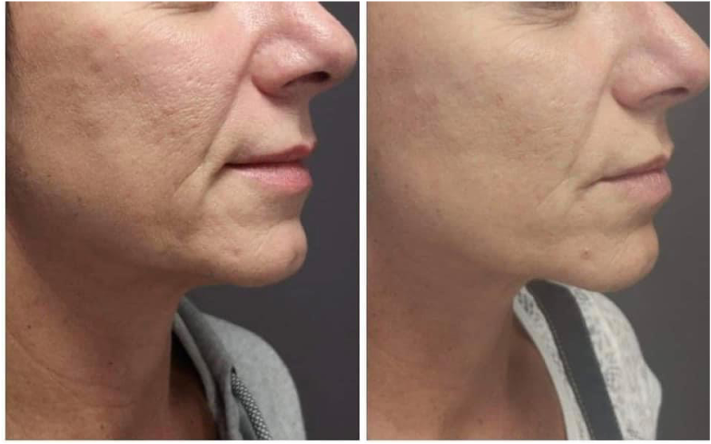 endolift sur ovale