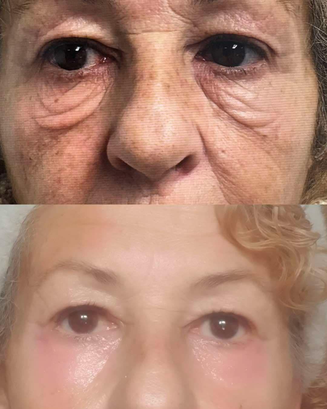 blepharoplastie realisée par le dr Quezel Guerraz