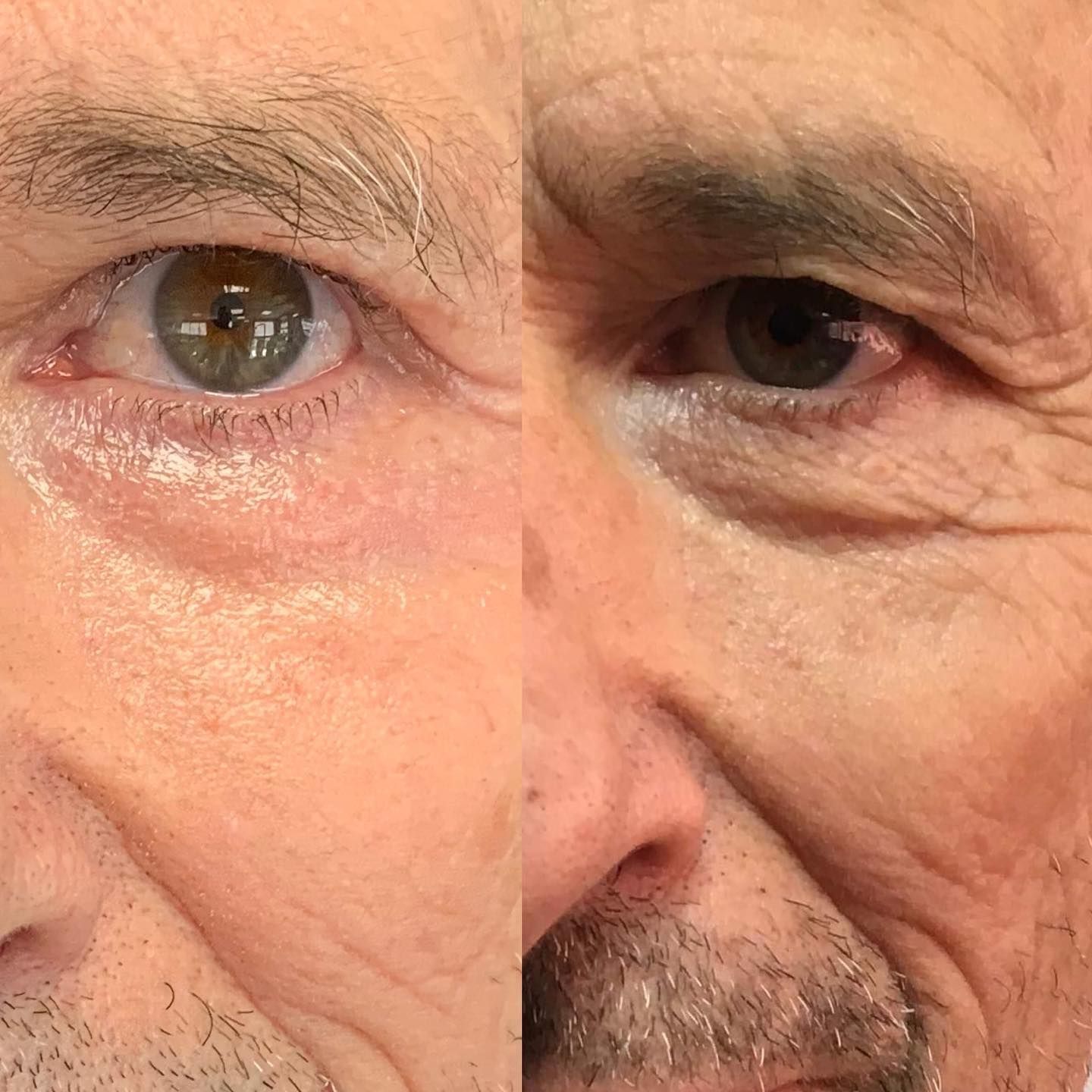 blepharoplastie medicale realisé par le docteur quezel guerraz a perpignan