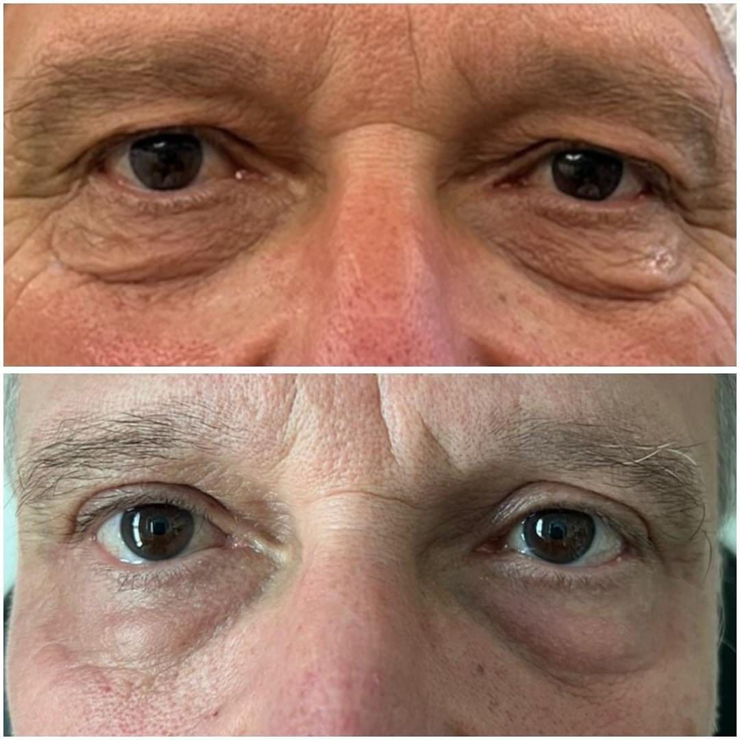 blepharoplastie medicale realisé par le docteur quezel guerraz a perpignan