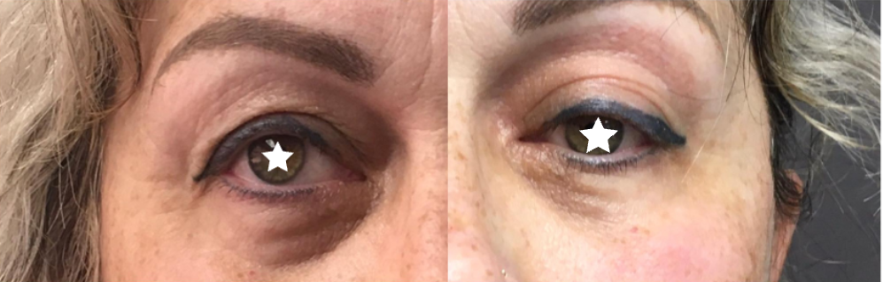 blepharoplastie avant/après blepharoplastie avant/après