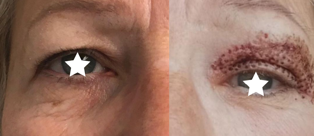 Rétractation cutanée visible dès la fin de l'intervention Rétractation cutanée visible dès la fin de l'intervention