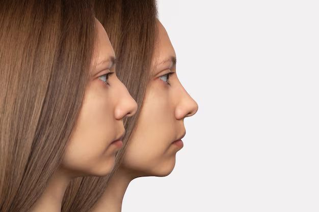 Rhinoplastie médicale SculptR® : une technique de précision sans chirurgie pour harmoniser la forme