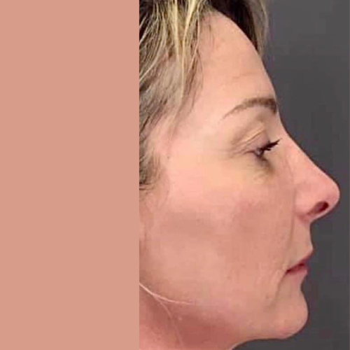 avant / apres endolift