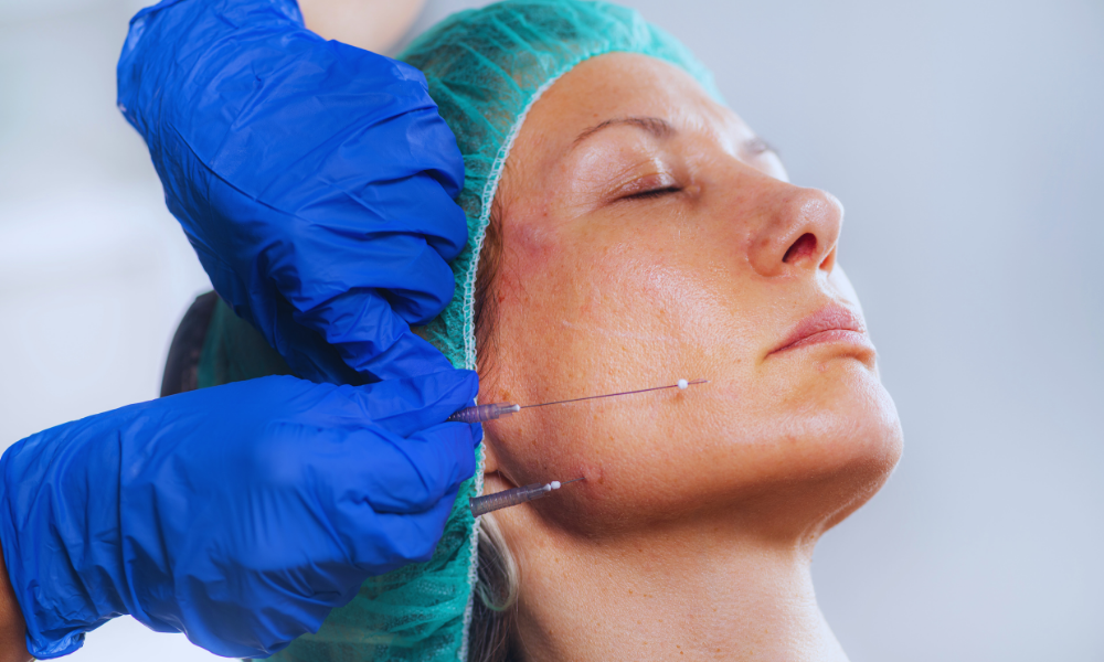 Les fils tenseurs sont une technique de médecine esthétique non chirurgicale qui permet de retendre