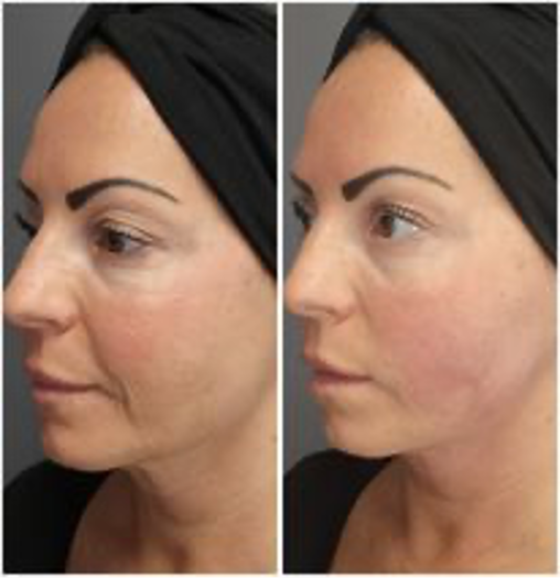 endolift sur ovale
