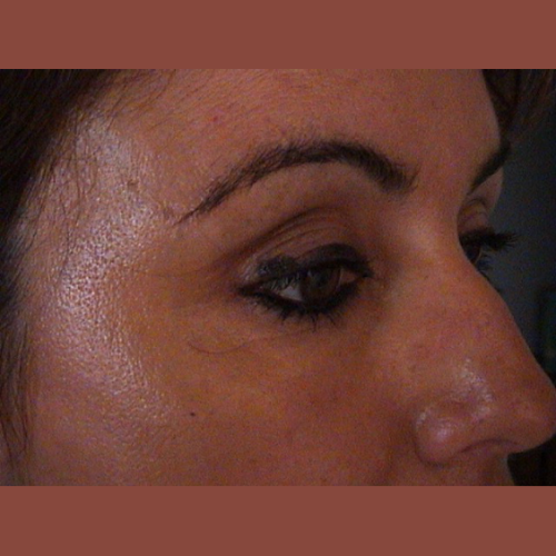apres botox