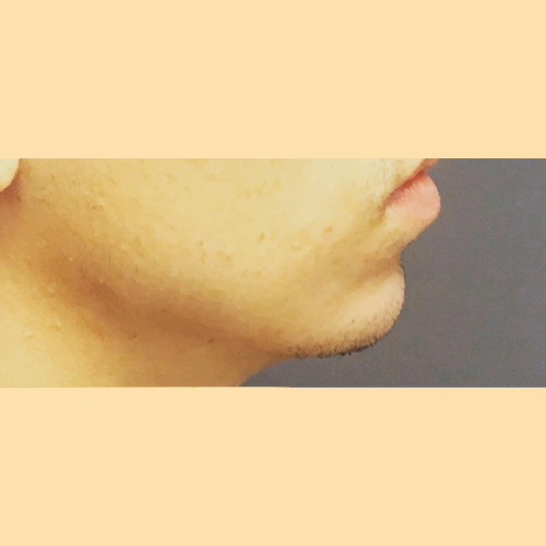 avant apres genioplastie