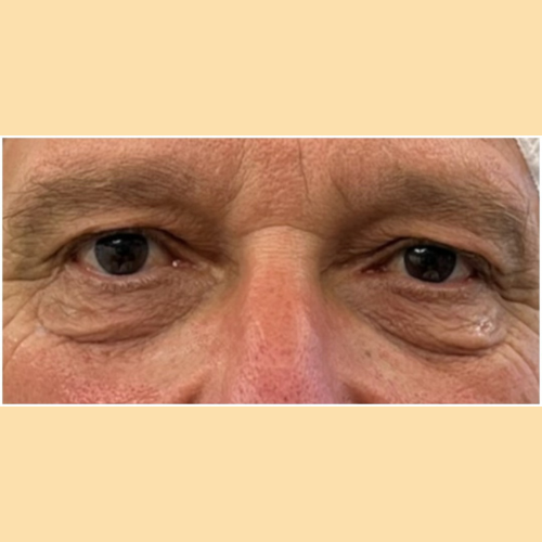 avant blepharoplastie