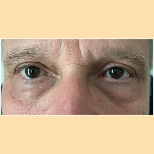 avant blepharoplastie