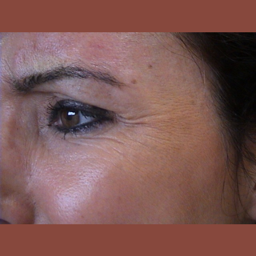 avant botox