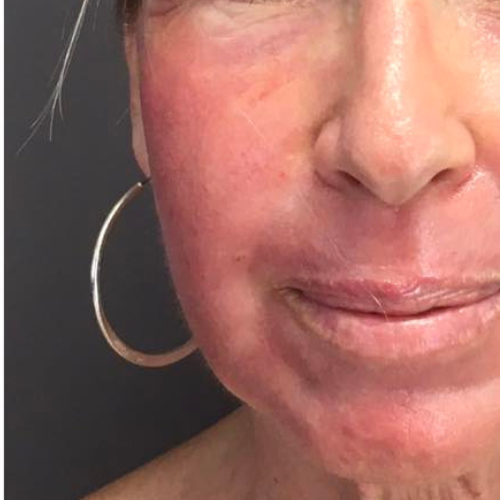 avant seance de peeling aux phenols
