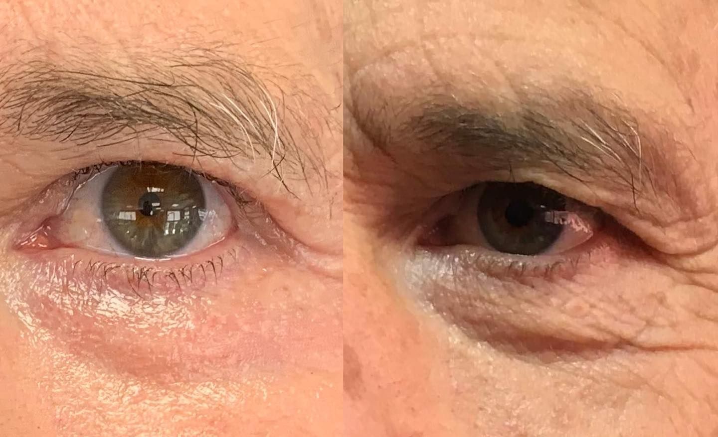 blepharoplastie medicale 1 mois