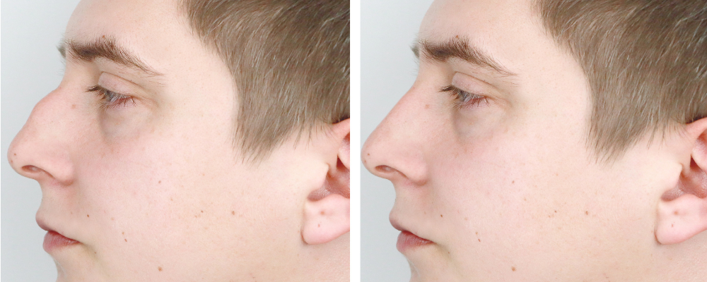 rhinoplastie avant apres