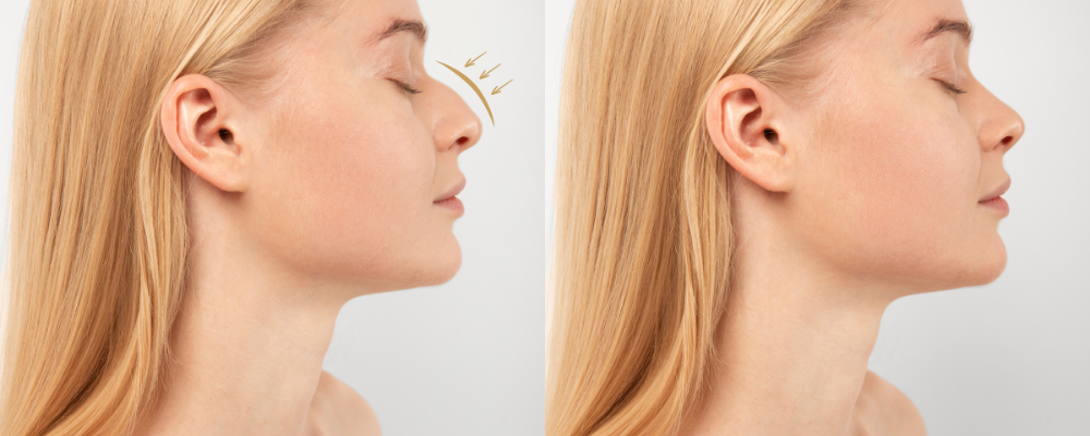 Rhinoplastie Médicale : Corriger son nez a perpignan