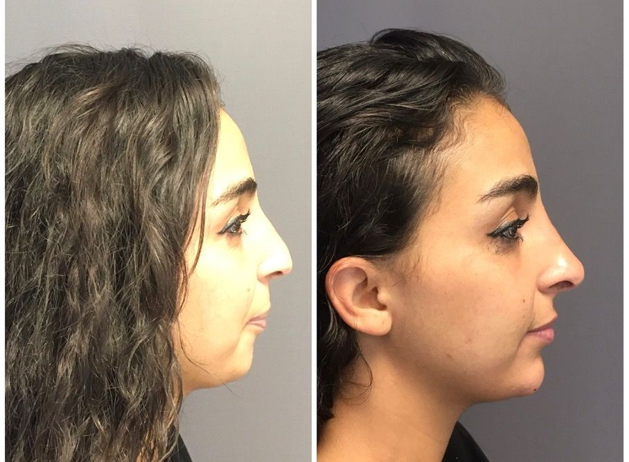 Rhinoplastie médicale