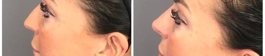 Rhinoplastie médicale