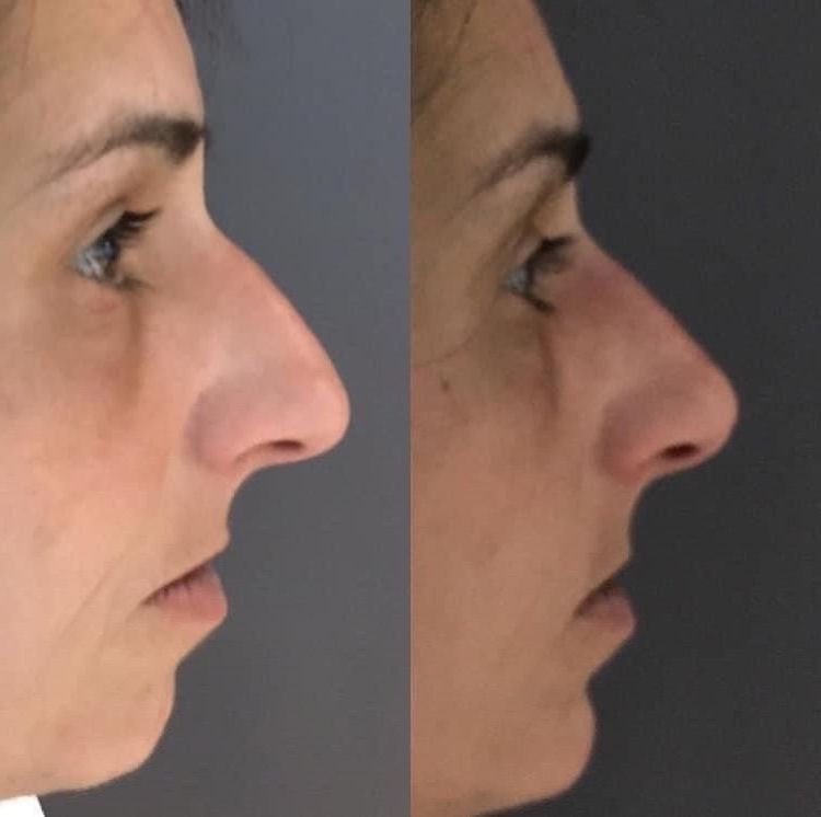 rhinoplastie medicale par le docteur Quezel Guerraz